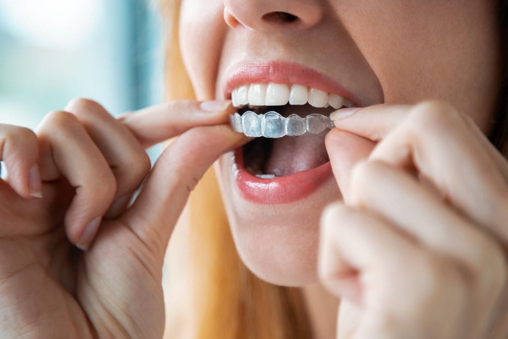 Invisalign in Encino