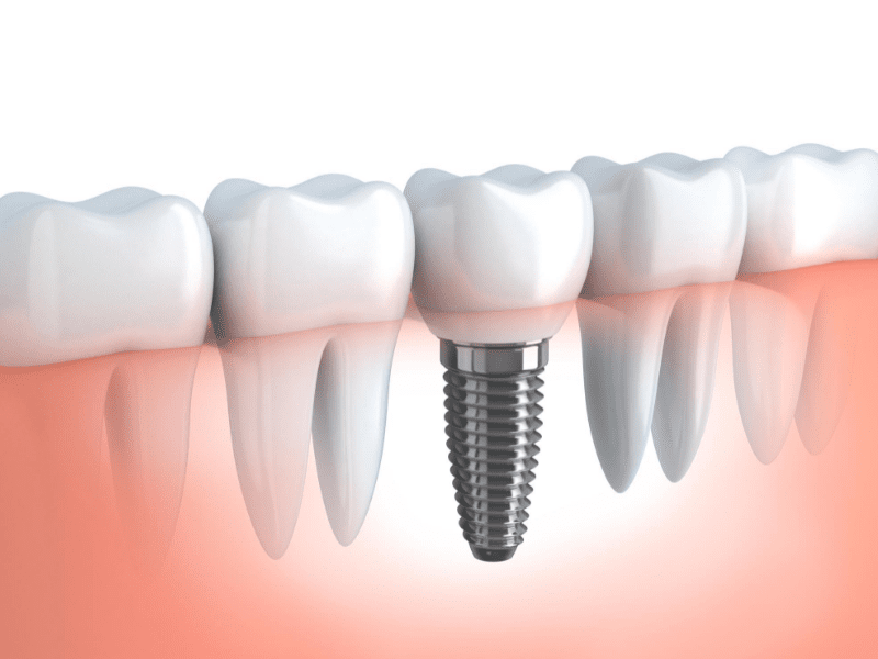 encino dentistry dental implants